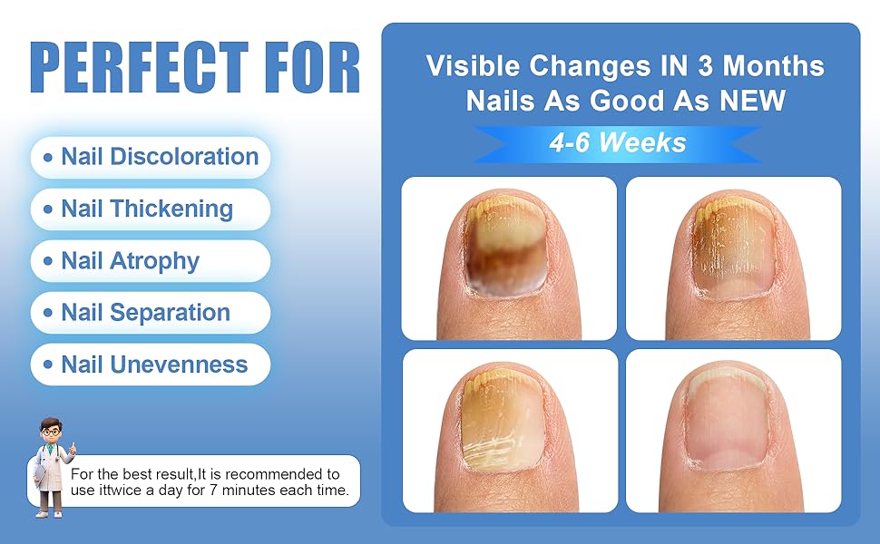 DISPOSITIVO LASER PARA ELIMINAR HONGOS